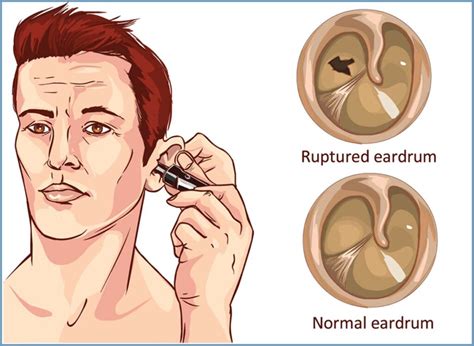 scratch test ear|Ruptured eardrum (perforated eardrum) .